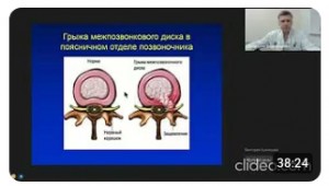 Лечение межпозвоночной (межпозвонковой) грыжи. Вебинар нейрохирурга Дурова Олега Владимировича