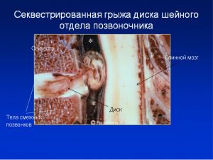 Шейная межпозвоночная грыжа