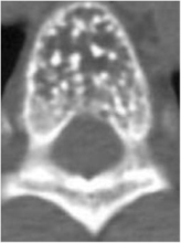 Кавернозная гемангиома 