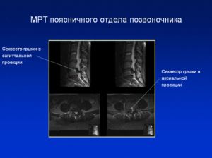 МРТ поясничного отдела позвоночника. Секвестрированная грыжа м_п диска L4-L5