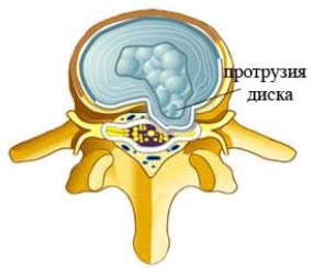Межпозвонковая грыжа