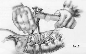 Рис.7-5. Схема миниинвазивной технологии транспедикулярной фиксации позвоночника. Выполняется проведение стержня в головки транспедикулярных винтов