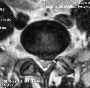 Рис. 9b. Магнитно-резонансная томография (МРТ) поясничного отдела позвоночника в сагиттальной (a) и аксиальной  (b) проекции. Стрелкой показана мп секвестрированная парамедианная грыжа диска L5-S1 слева. 