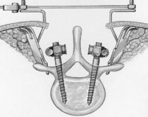 Рис. 1a. Схема введения винтов через дужки позвонка при транспедикулярной фиксации позвоночника.