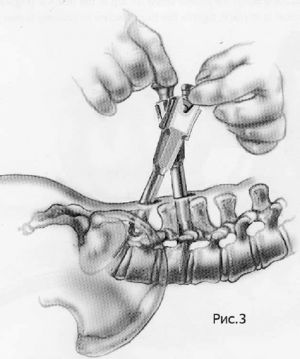 Рис.7-3. Схема миниинвазивной технологии транспедикулярной фиксации позвоночника. Два держателя винтов соединяются между собой специальным механизмом.