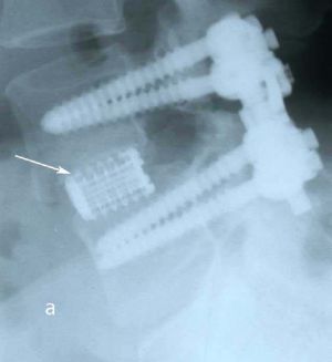 Рис. 6a. Рентгенограмма поясничного отдела позвоночника в боковой (а) и прямой (b) проекции после операции транспедикулярной фиксации L4-L5 позвонков. Стрелкой указаны 2 титановых цилиндрических кейджа. 