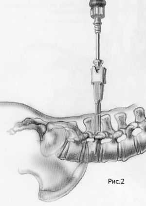 Рис.7-2. Схема миниинвазивной технологии транспедикулярной фиксации позвоночника. Введение по спице канюлированного винта в сборе с держателем.