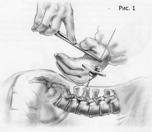 Рис.7-1. Схема миниинвазивной технологии транспедикулярной фиксации позвоночника. Введение спицы через иглу.