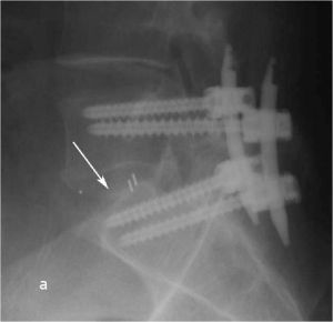 Рис. 10 a. Ренгенограмма поясничного отдела позвоночника в боковой (a) и прямой (b) проекции. Транспедикулярная фиксация L5-S1 позвонков титановой конструкцией канюлированными винтами, межтеловая фиксация позвонков кейджем из PEEK-керамики. Стрелкой указано положение ренген–негативного кейджа, видны титановые метки кейджа.
