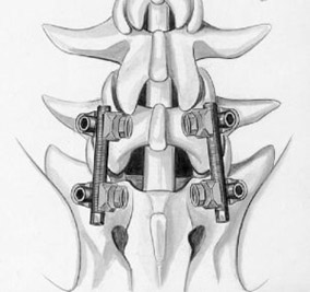 Рис. 1b. Схема транспедикулярной фиксации L5-S1 позвонков титановой конструкцией. Окончательный вид конструкции в сборе (вид сверху)
