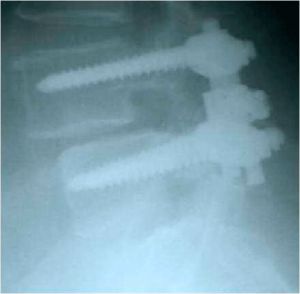 Рис. 9 a. Ренгенограмма поясничного отдела позвоночника в боковой (a) и прямой (b) проекции. Транспедикулярная фиксация  L4-L5 позвонков титановой конструкцией, удалена дужка L4 позвонка.