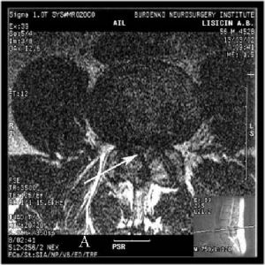 Рис.2А. МРТ поясничного отдела позвоночника  на уровне L4-L5 позвонков