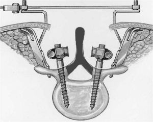 Рис.6а. Схема введения винтов через дужки позвонка при  транспедикулярной фиксации позвоночника. Серым цветом  указана зона удаления дужки позвонка. 