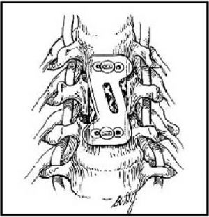 Рис.8а. Схема установки сетчатого импланта MESH между телами позвонков и фиксация титановой пластиной смежных позвонков