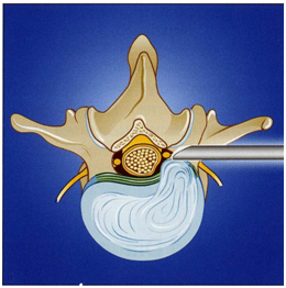 Рис.2. Схема трансфораминального эндоскопического удаления грыжи диска Рис.2. Схема трансфораминального эндоскопического удаления грыжи диска