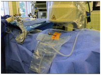 Рис.3. Операция проводится под контролем ЭОПа через прокол без разреза Рис.3. Операция проводится под контролем ЭОПа через прокол без разреза